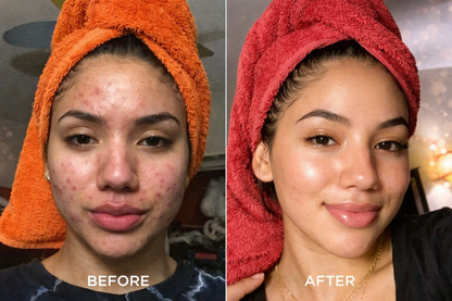 Seloria Beauty Rice Peel Serum Ampoule™